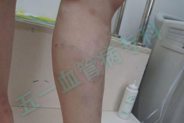 静脉曲张是一种常见的疾病，以下是沈阳静脉曲张的10大忌！