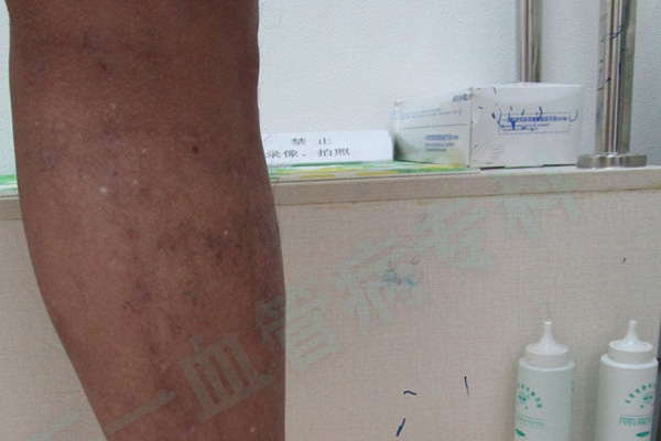 静脉曲张和脉管炎有什么区别？济南静脉曲张专科医院列出静脉曲张和脉管炎是两种不同的血管疾病！