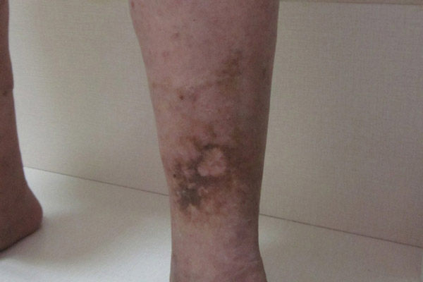 静脉曲张和血管瘤有什么区别？沈阳静脉曲张微创手术在病理特征、临床表现和治疗方法上都有所不同！