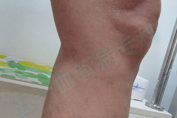 静脉曲张和淋巴水肿的区别，青岛静脉曲张专科医院鉴别诊断