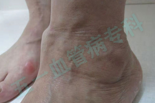 静脉曲张和动脉硬化有什么区别？沈阳静脉曲张专科医院五一静脉曲张专科将对这两种疾病进行比较和分析！