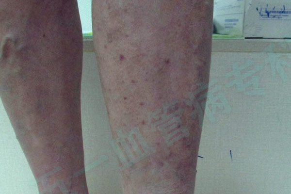 静脉曲张除了影响腿的美观外,还会引发许多不适症状! 静脉曲张除了影响腿的美观外,还会引发许多不适症状!