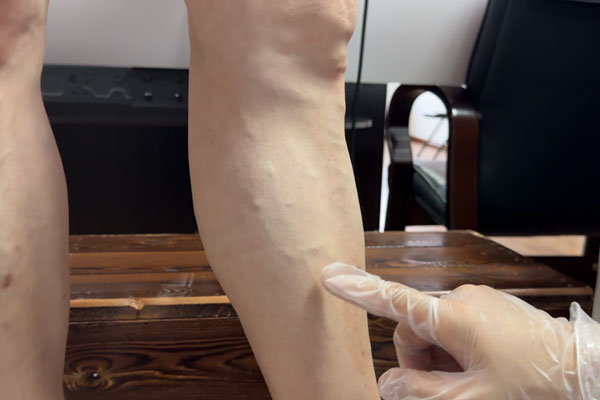 大连静脉曲张专科医院治疗静脉曲张血栓,静动脉硬化！