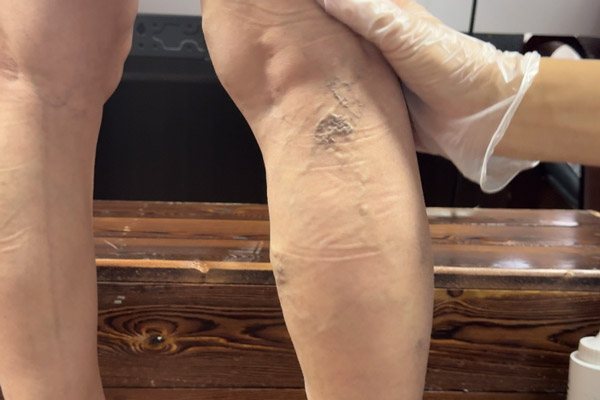 探索沈阳静脉曲张的综合治疗方案：中西医结合在治疗过程中的优势